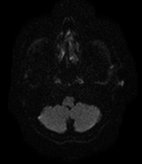 File:Bilateral thalamic glioma (Radiopaedia 65852-75009 Axial DWI 2).jpg