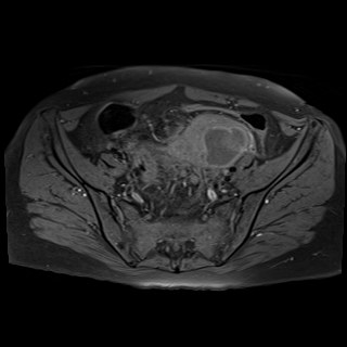 Bilateral tubo-ovarian abscesses (Radiopaedia 58635-65829 Axial T1 fat sat 12).jpg
