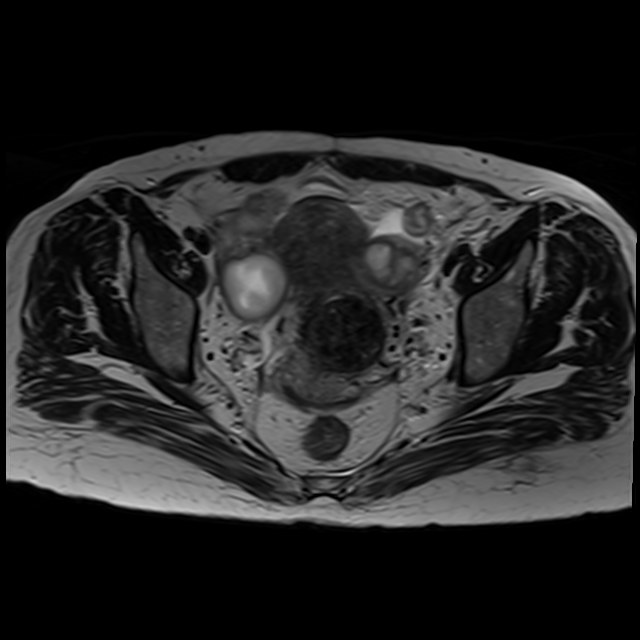 Bilateral tubo-ovarian abscesses (Radiopaedia 58635-65829 Axial T2 26).jpg