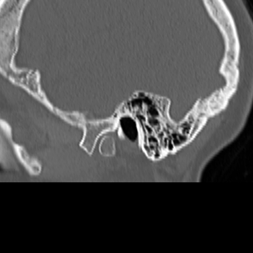File:Bilateral tympanoplasty (Radiopaedia 16947-16664 Sagittal bone window 2).jpg