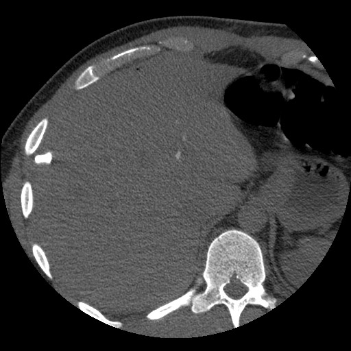 Bile leak from liver traumatic laceration (Radiopaedia 63463-72077 Axial Biliscopin 24).jpg