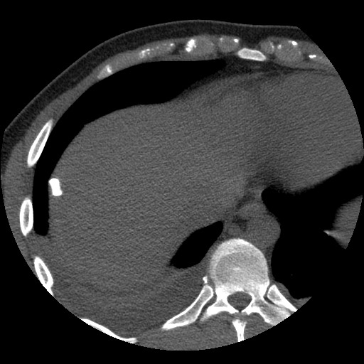 Bile leak from liver traumatic laceration (Radiopaedia 63463-72077 Axial Biliscopin 9).jpg