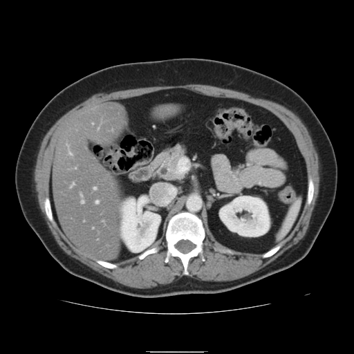 File:Billroth I gastric resection (Radiopaedia 17685-17425 None 6).jpg