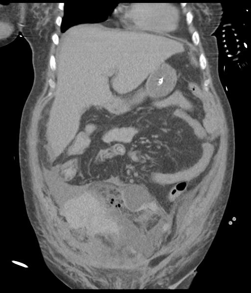 Bladder rupture post renal biopsy (Radiopaedia 30863-31572 Coronal non-contrast 21).jpg