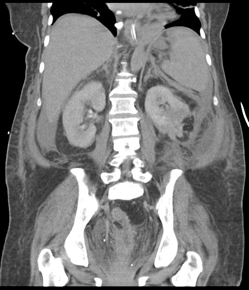 Bladder rupture post renal biopsy (Radiopaedia 30863-31572 Coronal non-contrast 39).jpg