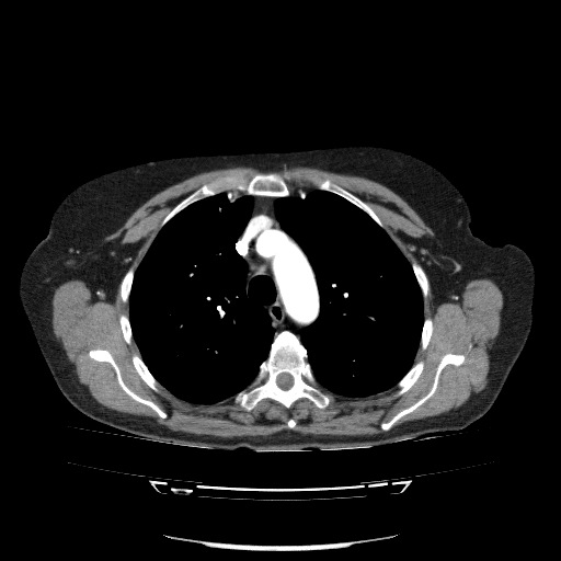 File:Bladder tumor detected on trauma CT (Radiopaedia 51809-57609 A 32).jpg