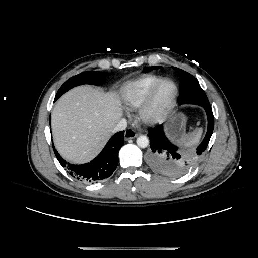 Blunt abdominal trauma with solid organ and musculoskelatal injury with active extravasation (Radiopaedia 68364-77895 A 12).jpg