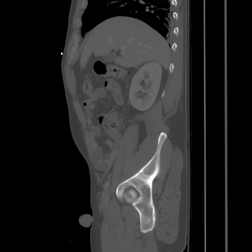 Blunt abdominal trauma with solid organ and musculoskelatal injury with active extravasation (Radiopaedia 68364-77895 Sagittal bone window 25).jpg