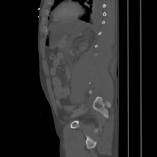 File:Blunt abdominal trauma with solid organ and musculoskelatal injury with active extravasation (Radiopaedia 68364-77895 Sagittal bone window 68).jpg