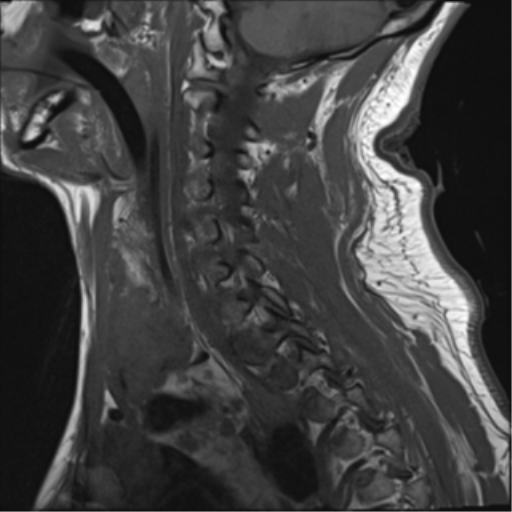 File:Blunt cerebrovascular injury (Radiopaedia 53682-59744 Sagittal T1 12).png
