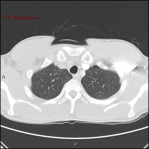 Blunt chest trauma - pulmonary interstitial emphysema and pneumomediastinum (Radiopaedia 20666-20552 Axial lung window 10).jpg