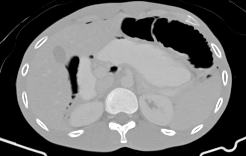 Blunt injury to the small bowel (Radiopaedia 74953-85987 Axial Wide 18).jpg