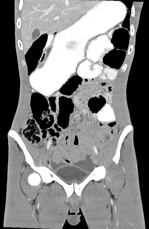 Blunt injury to the small bowel (Radiopaedia 74953-85987 B 35).jpg