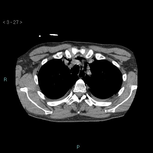 Boerhaave syndrome (Radiopaedia 27683-27897 oral contrast 27).jpg