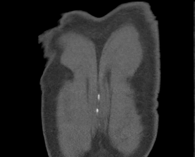 File:Boerhaave syndrome (Radiopaedia 39382-41660 C 88).png