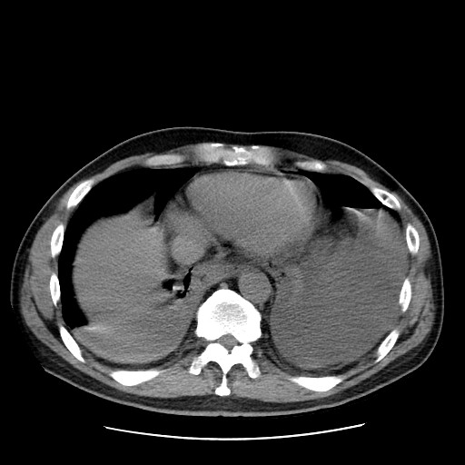 File:Boerhaave syndrome (Radiopaedia 59796-67310 Axial liver window 48).jpg