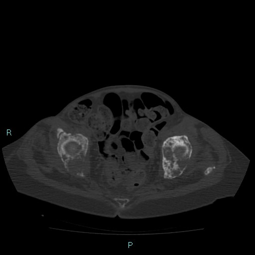 File:Bone metastases from untreated breast cancer (Radiopaedia 42973-46219 Axial bone window 177).jpg