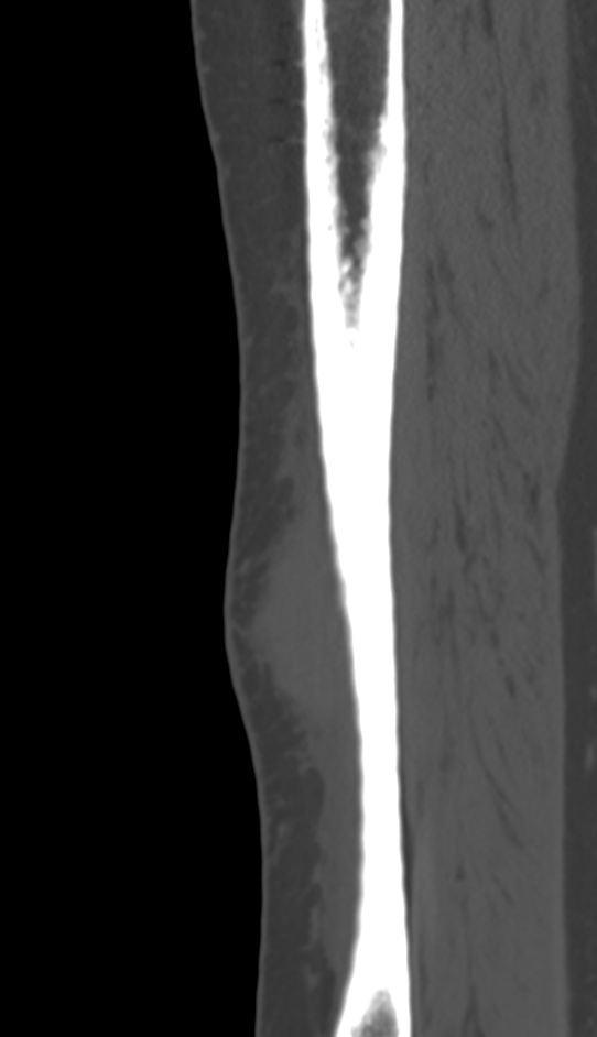 Bone metastasis - tibia (Radiopaedia 57665-64609 Sagittal bone window 47).jpg