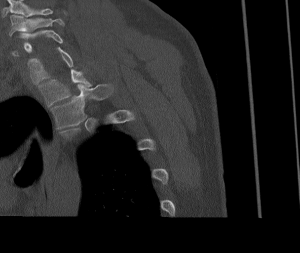 Bony Bankart and Hill-Sachs lesions (Radiopaedia 33622-34727 Sagittal bone window 77).png