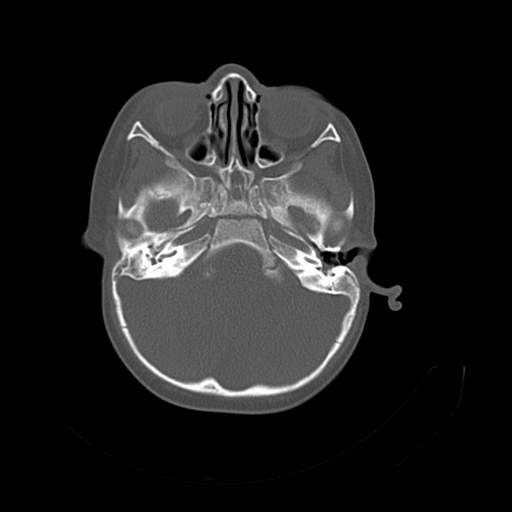 File:Bony atresia of the right external auditory canal (Radiopaedia 27916-28156 Axial bone window 5).jpg