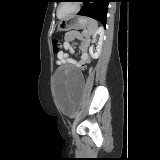 File:Borderline mucinous tumor (ovary) (Radiopaedia 78228-90808 B 46).jpg