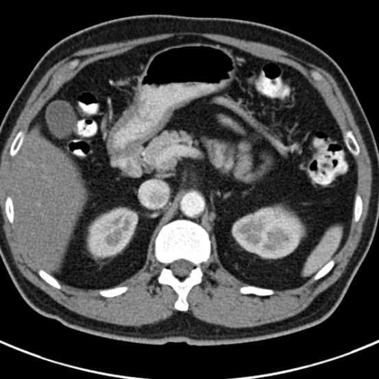 File:Bosniak cyst - type IV (Radiopaedia 23525-23627 renal cortical phase 12).jpg
