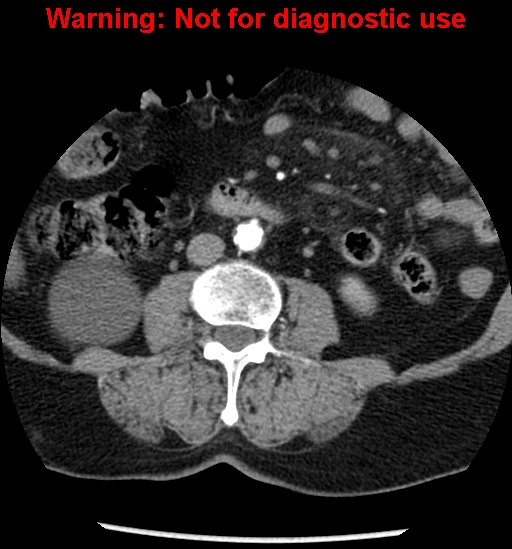 File:Bosniak renal cyst - type II (Radiopaedia 23404-23468 B 30).jpg
