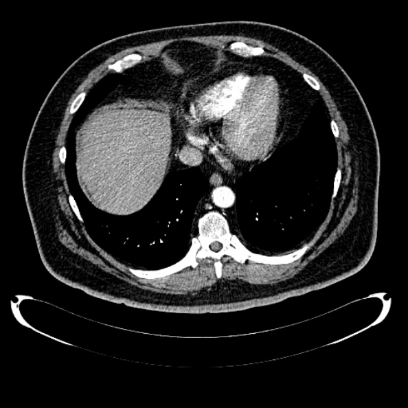 File:Bosniak renal cyst - type IV (Radiopaedia 24244-24518 B 17).jpg