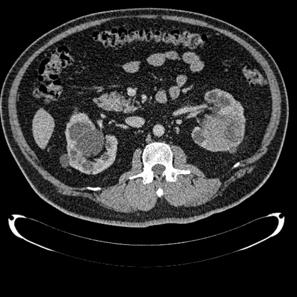Bosniak renal cyst - type IV (Radiopaedia 24244-24518 C 148).jpg