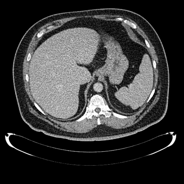 File:Bosniak renal cyst - type IV (Radiopaedia 24244-24518 C 55).jpg