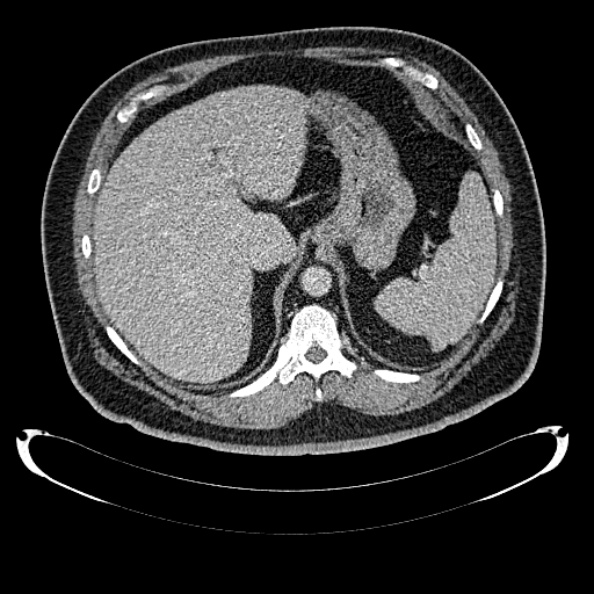 Bosniak renal cyst - type IV (Radiopaedia 24244-24518 C 58).jpg