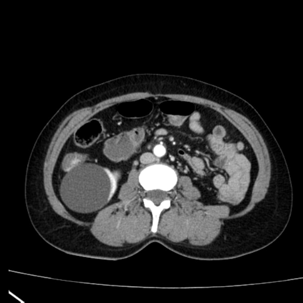 Bosniak renal cyst - type I (Radiopaedia 27479-27675 renal cortical phase 45).jpg