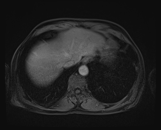 File:Bouveret syndrome (Radiopaedia 61017-68856 Axial T1 C+ fat sat 11).jpg