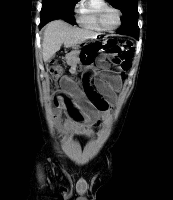 Bowel obstruction from colon carcinoma (Radiopaedia 22995-23028 C 16).jpg