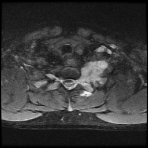File:Brachial plexus neurofibroma (Radiopaedia 28030-28291 Axial STIR 4).png