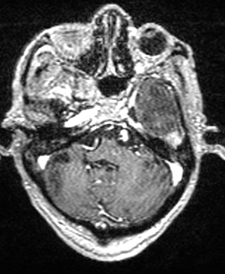 Brain abscess with dual rim sign (Radiopaedia 87566-103938 Axial T1 C+ 43).jpg