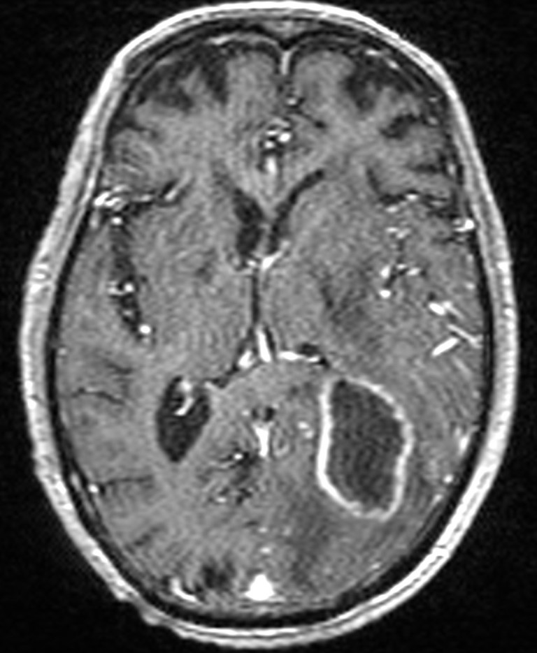 Brain abscess with dual rim sign (Radiopaedia 87566-103938 Axial T1 C+ 87).jpg