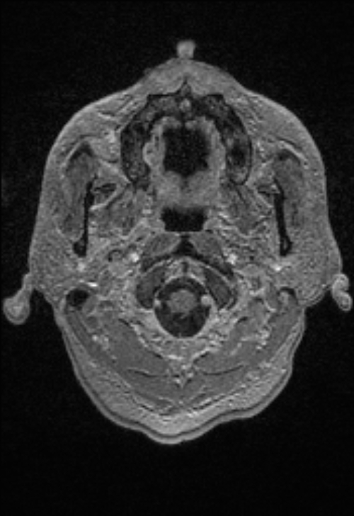 Brain abscess with ventriculitis (Radiopaedia 85703-101495 Axial T1 C+ 14).jpg