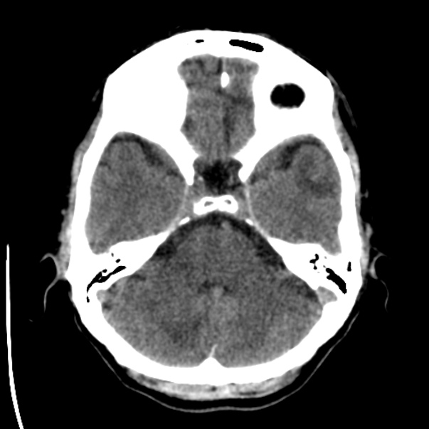 Brain metastases from lung cancer (Radiopaedia 24480-24781 Axial non-contrast 11).jpg