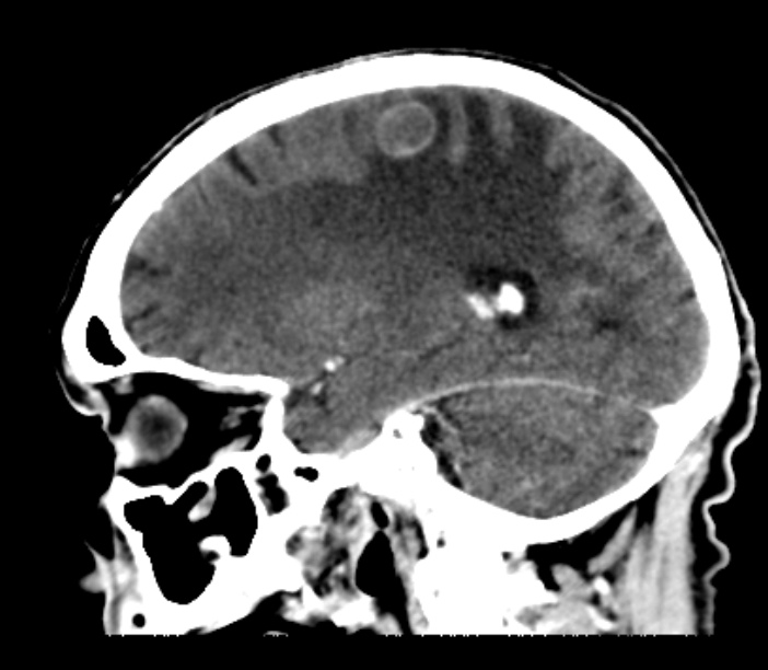 Brain metastases from lung cancer (Radiopaedia 27849-28092 Sagittal C+ delayed 23).jpg