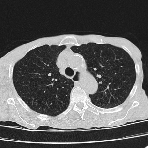 Brain metastases from lung cancer (Radiopaedia 27849-28093 Axial lung window 20).jpg