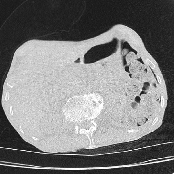 Brain metastases from lung cancer (Radiopaedia 27849-28093 Axial lung window 65).jpg