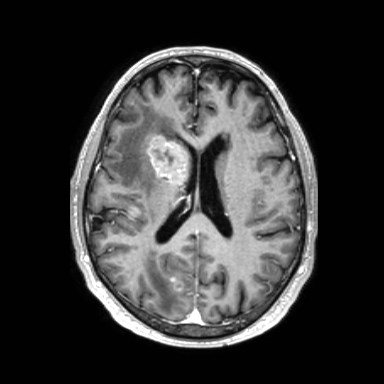 Brain metastases from lung cancer (Radiopaedia 83839-99028 Axial T1 C+ 39).jpg
