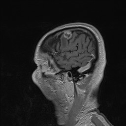 Brain metastasis (Radiopaedia 42617-45761 Sagittal T1 C+ 14).jpg
