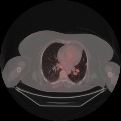 Brain metastasis (Radiopaedia 89847-106962 Axial lung window 33).jpg