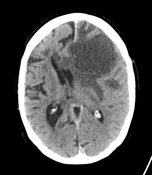 File:Brain metastasis (lung cancer) (Radiopaedia 48289-53177 Axial non-contrast 18).png