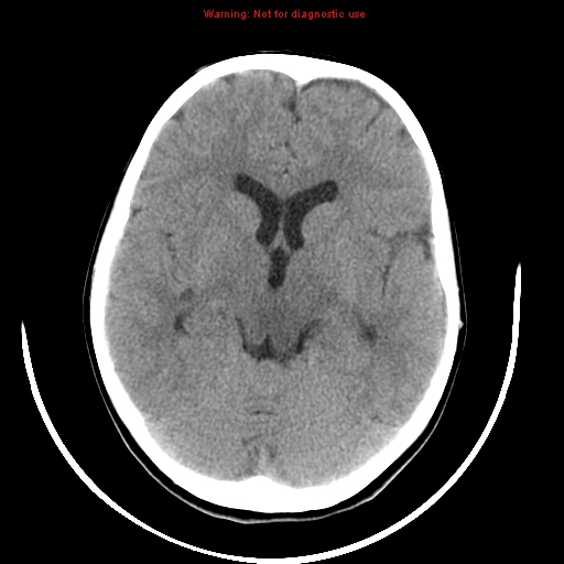 File:Brainstem glioma (Radiopaedia 9444-10123 non-contrast 10).jpg