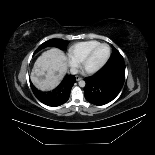 Breast cancer pseudocirrhosis after chemotherapy (Radiopaedia 65407-74457 A 11).jpg