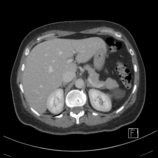 Breast metastases from renal cell cancer (Radiopaedia 79220-92225 C 23).jpg