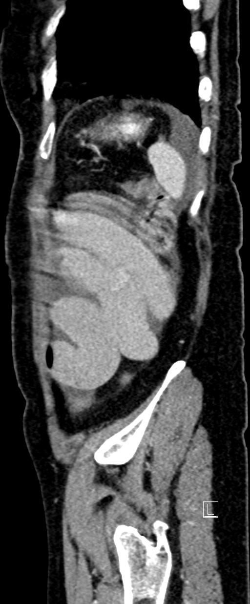 Broad ligament hernia (Radiopaedia 84802-100276 C 6).jpg